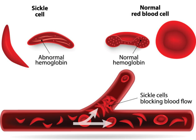 Diagrama que muestra glóbulos falciformes y regulares