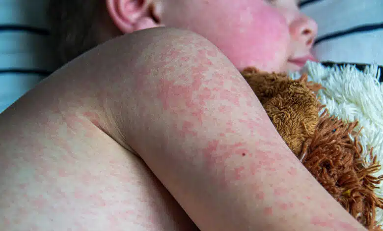 a photo of a measles rash on the torso of a young boy lying in bed